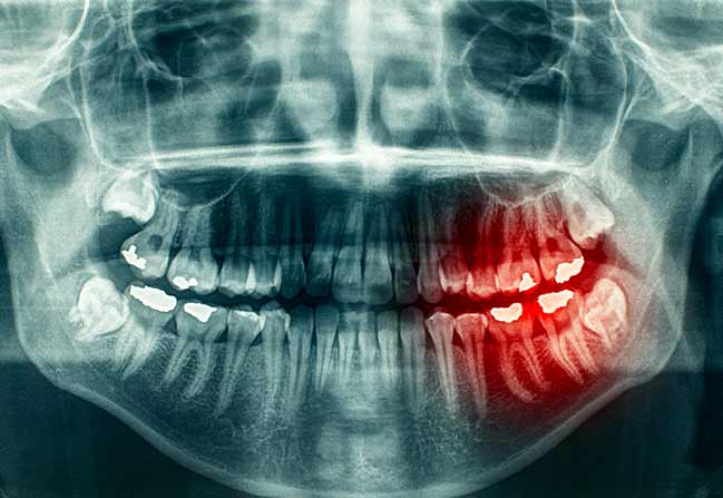 nw-calgary-dental-bone-grafting NW Calgary Bone Grafting | Scenic Acres Dental Centre | NW Calgary