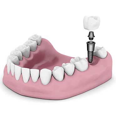 NW Calgary Dental Implant Restorations | Scenic Acres Dental Centre
