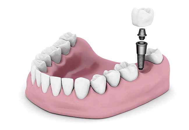 NW Calgary Dental Implant Restorations | Scenic Acres Dental Centre