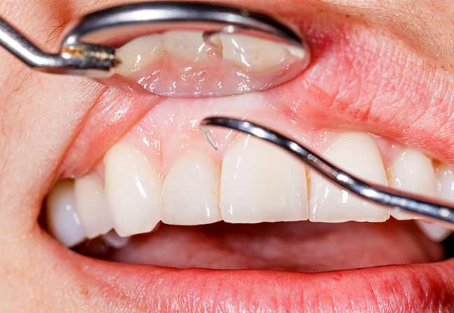 NW Calgary Periodontal Gum Therapy | Scenic Acres Dental Centre | NW Calgary