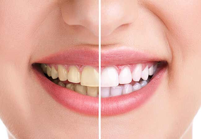 NW Calgary Teeth Whitening | Scenic Acres Dental Centre