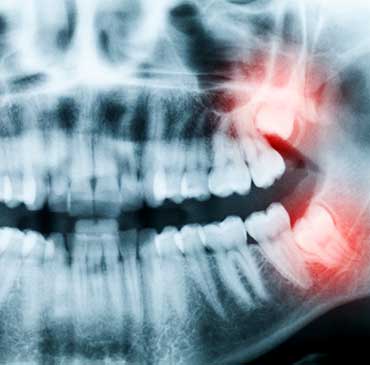 NW Calgary Wisdom Teeth Extraction | Scenic Acres Dental Centre