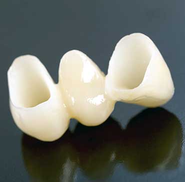 NW Calgary Dental Bridge | Scenic Acres Dental Centre | NW Calgary