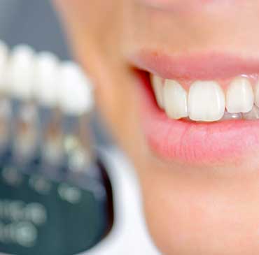 NW Calgary Porcelain Veneers | Scenic Acres Dental Centre | NW Calgary