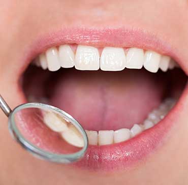 NW Calgary White Fillings | Scenic Acres Dental Centre | NW Calgary